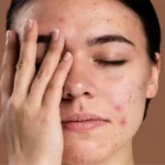 Top 10 Natural Remedies to Effectively Remove Dark Spots