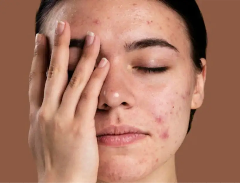 Top 10 Natural Remedies to Effectively Remove Dark Spots