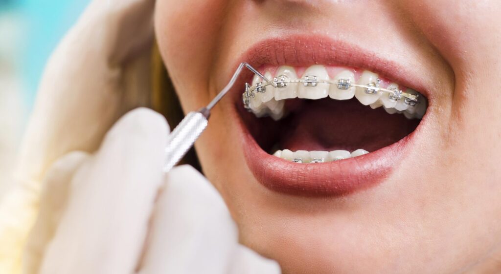 Orthodontic Treatment