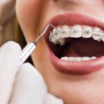 Orthodontic Treatment