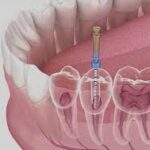 What Should I Expect During a Root Canal Treatment?