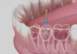 What Should I Expect During a Root Canal Treatment?